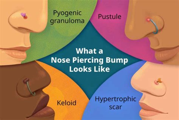Can a nose piercing fall out?
