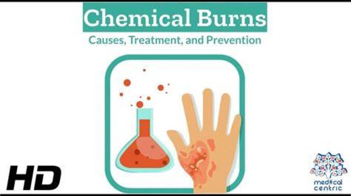 Can Betadine cause a chemical burn?