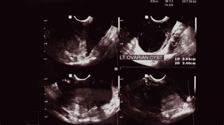 Can tampons cause cysts?