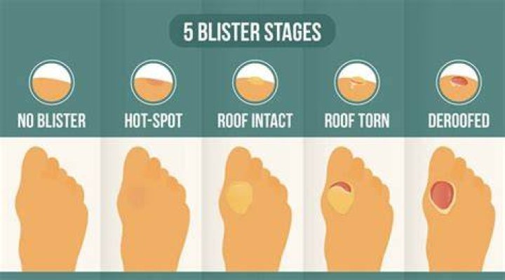 Do blister bandages work?