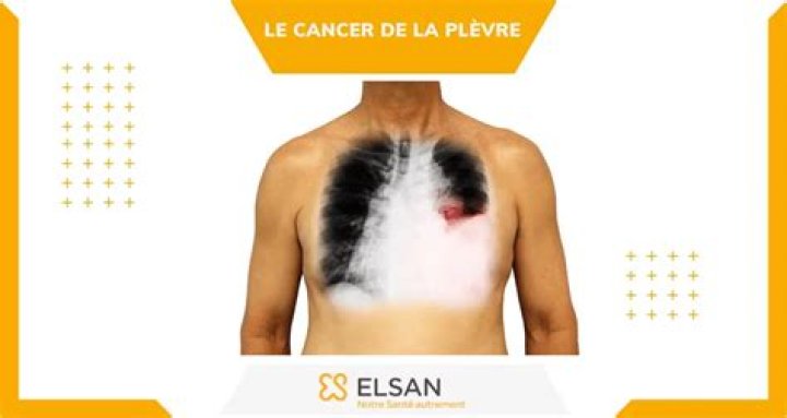 Quels sont les signes du cancer de la Plevre ?