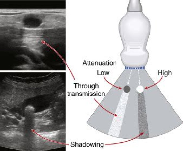 What causes acoustic shadowing in ultrasound?