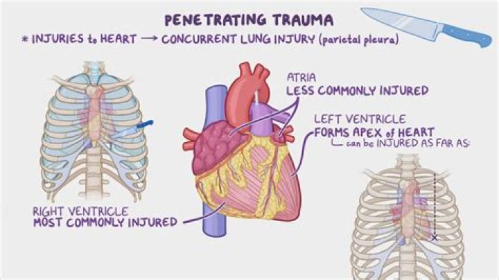 What is cardiac trauma?