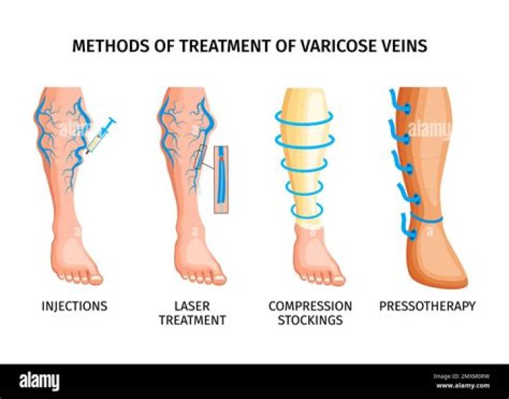 What to do for bleeding varicose veins?